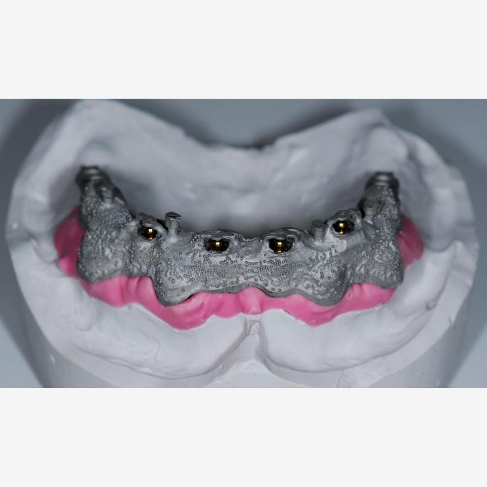 Overdenture su barra | It Dental